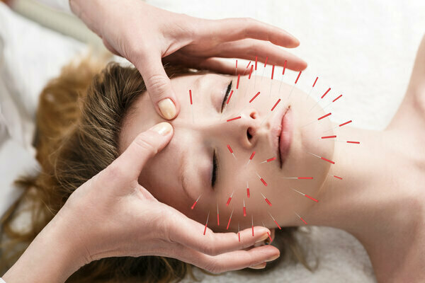 In che modo l'agopuntura può aiutarci per il mal di testa?