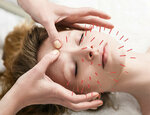 In che modo l'agopuntura può aiutarci per il mal di testa?